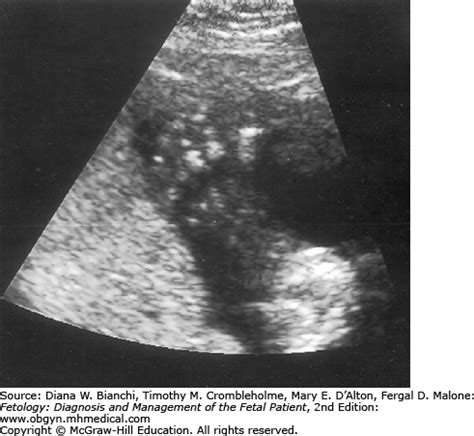 ellisvan creveld syndrome obgyn key