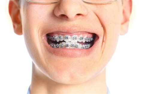 dental braces are challenging in so many ways dr medina 702 368 3627