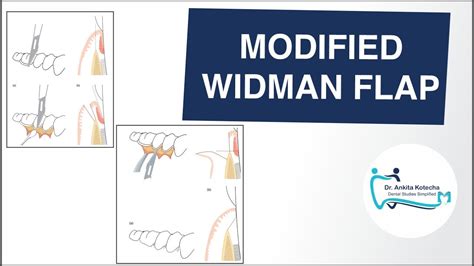 modified widman flap open flap curettage periodontal surgical