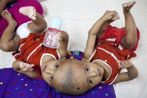 Twin Girls Whose Mother Didn T Realise They Were Conjoined Until Birth