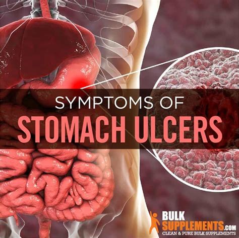 Stomach Ulcers Causes Symptoms And Treatment