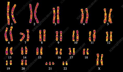 Downs Syndrome Karyotype Stock Image C001 8378 Science Photo Library