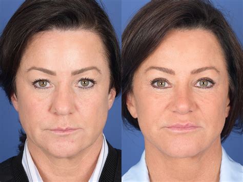 Rhinoplasty Before And After 82 Weber Facial Plastic Surgery