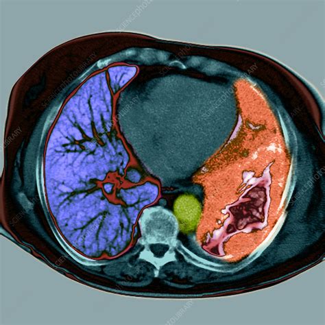 Lung Cancer Ct Scan Stock Image M134 0562 Science