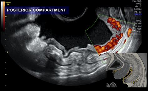 Preoperative Ultrasound Assessment Of Pelvic And Abdominal Spread In