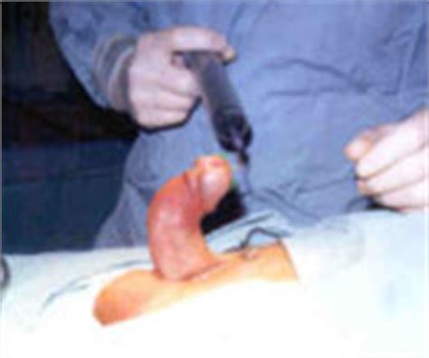 Can masturbation cause a crooked penis