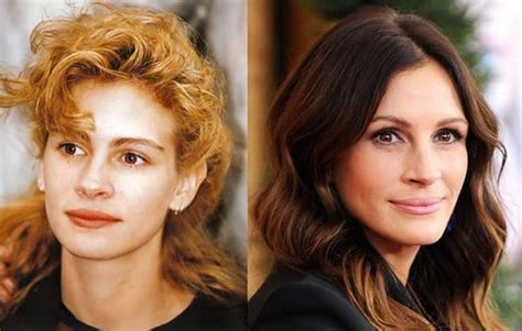 Has Julia Roberts Undergone A Plastic Surgery