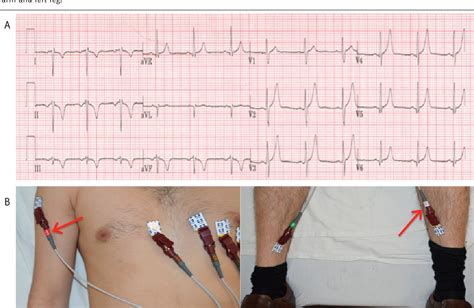 figure   common ecg lead placement errors part  limb lead reversals semantic scholar