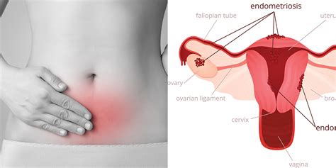 5 Common Endometriosis Symptoms Self