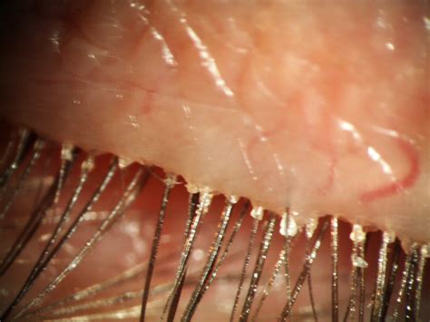 demodex eyelash mites