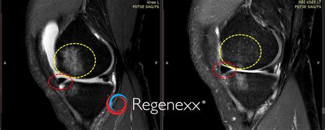 culture expanded stem cells  knee arthritis regenexx