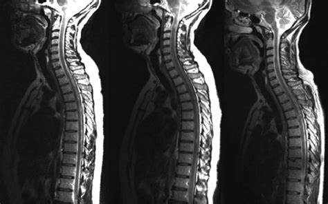 Early Mri Scans Could Predict Multiple Sclerosis Disability Ucl News