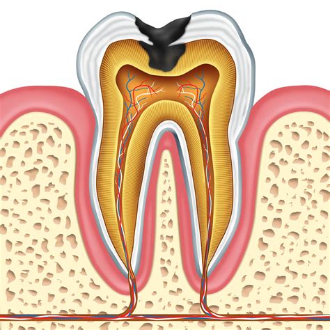 charleston sc   small cavities  lead  tooth losssocial