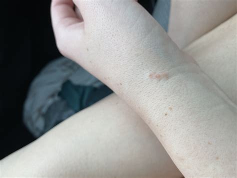 random bumps   side   wrists scabies forums patient