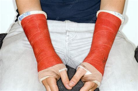 broken wrists in plaster casts stock image c008 3690 science