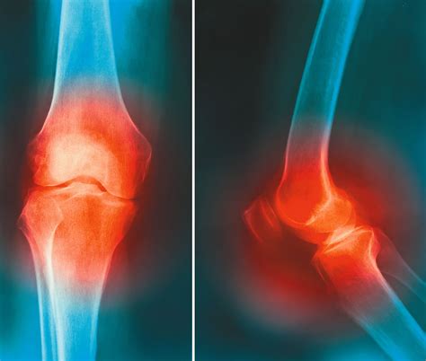 osteoarthritis and exercise tufts health and nutrition letter
