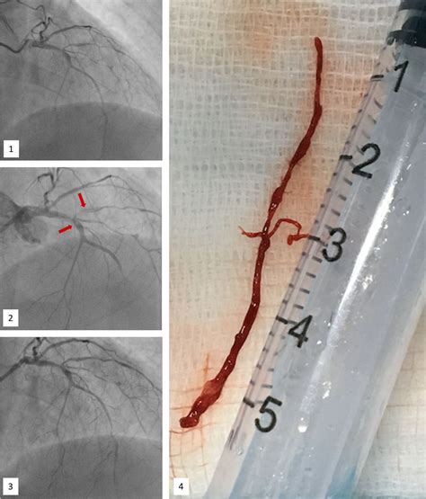 management  percutaneous coronary intervention complications heart