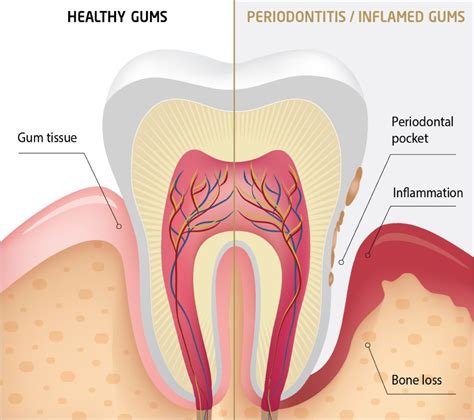 periodontal diseases treated