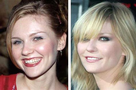 Kirsten Dunst Plastic Surgery Boob Job Teeth Nose Job