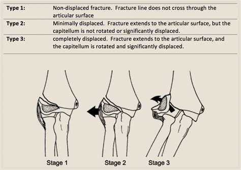 clinical practice guidelines lateral condyle fracture   humerus