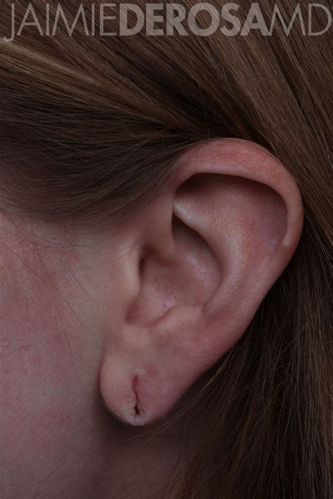 Boston Woman Has Her Stretched Earlobe Piercings Repaired