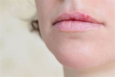 how to get rid of bumps on lips