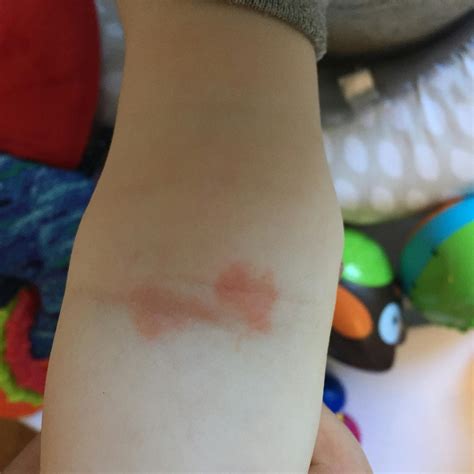 small rash  crease  babys arm winnie