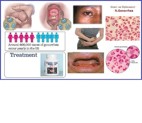 Gonorrhea Men And Women Antibacterial Anti Inflammatory 311845344984