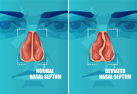 nasal septum deviation symptoms  treatment