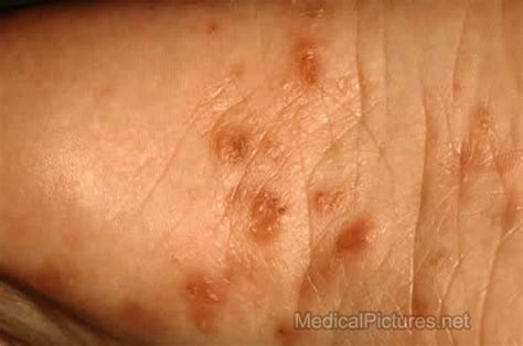 scabies pictures