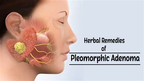herbal treatment  pleomorphic adenomas symptoms diagnosis