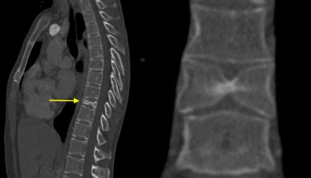 Case su due livelli progetti scale di design in legno, . Butterfly vertebra - Radiology at St. Vincent's University Hospital
