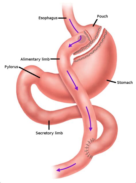 Understanding The Effects Of Roux En Y Gastric Bypass