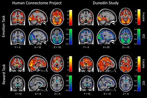 duke study  fmri brain scans  post concussion syndrome detection