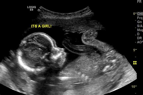 Is This Really A Girl 20wk Ultrasound