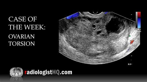 case   week ovarian torsion ultrasound youtube