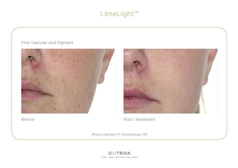 limelight laser facial victorias cosmetic medical clinic