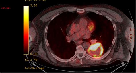Non Small Cell Lung Carcinoma Metastasis To The Anus Bmj Case Reports