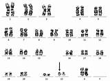 Banding Chromosome Karyotype Indicated Bcr sketch template