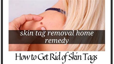 skin tag removal home remedy how to get rid of skin tags youtube