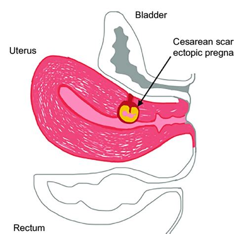 Figure Anatomic Depiction Of Uterus With Cesarean Scar Ectopic