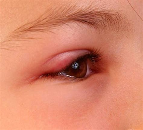 swollen eyelid symptoms treatment pictures  healdove