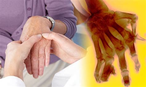 rheumatoid arthritis early warning signs to help spot the condition