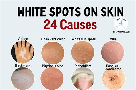 white spots  skin   pictures treatment