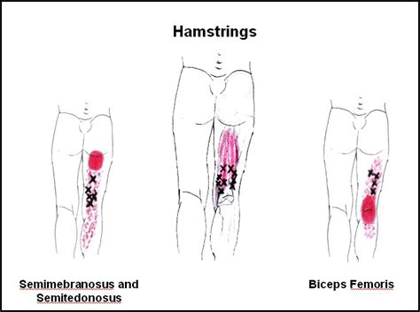 Lower Back Pain Trigger Points