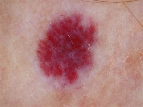 cherry angioma in adults removal pictures treatment