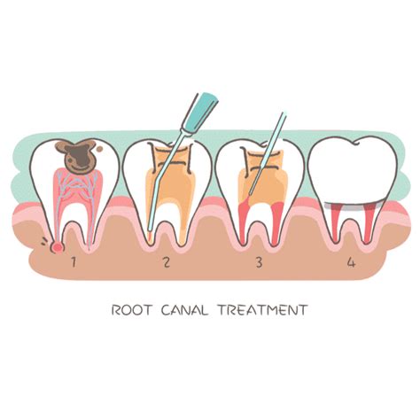root canal treatments   expect midland dental hub