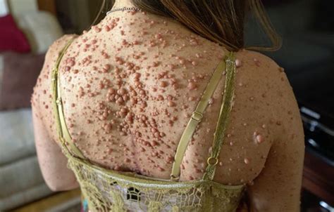 Rare Skin Disease Leaves Woman Covered In Almost 6 000 Tumours