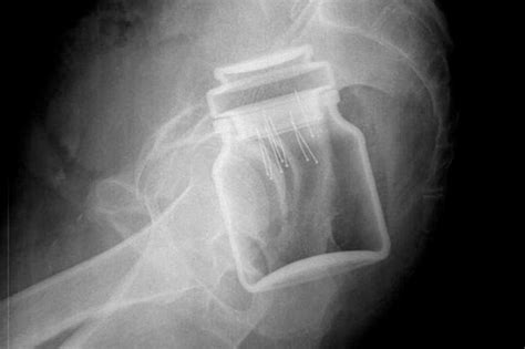 Man Gets Coffee Jar Stuck Up Bottom Worst Sexual Misadventure X Rays