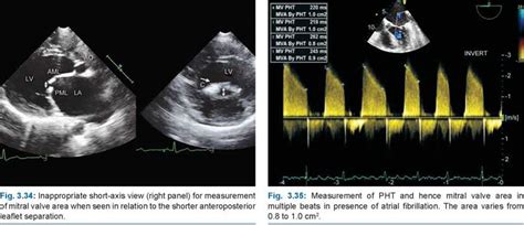 Mitral Stenosis A Practical Approach To Clinical